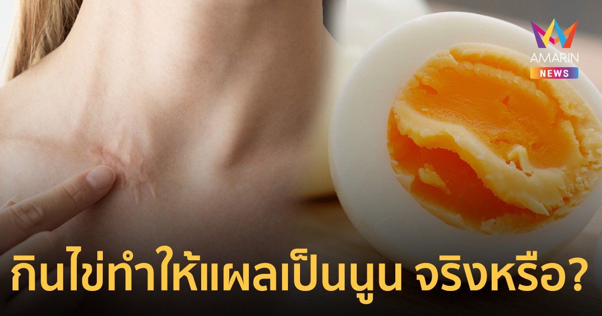 กินไข่ทำให้แผลเป็นนูน จริงหรือไม่? แนะ 6 เดือนแรกให้ทำตามนี้ช่วยลดการนูนของแผล