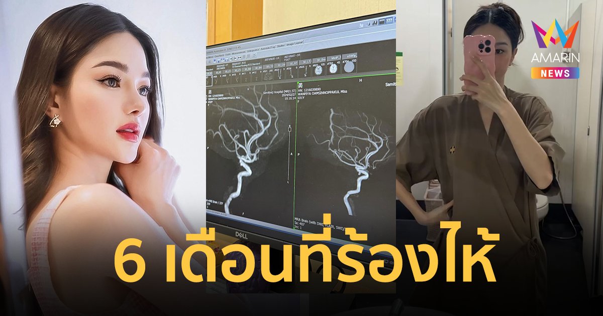 “กวาง วรรณปิยะ” เล่าอดทน 6 เดือน ป่วยคล้ายเส้นเลือดในสมองโป่งพอง