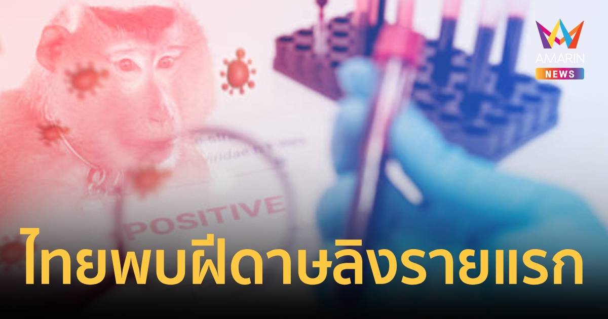 ด่วน พบผู้ป่วยสงสัยฝีดาษวานร รายแรกในไทย