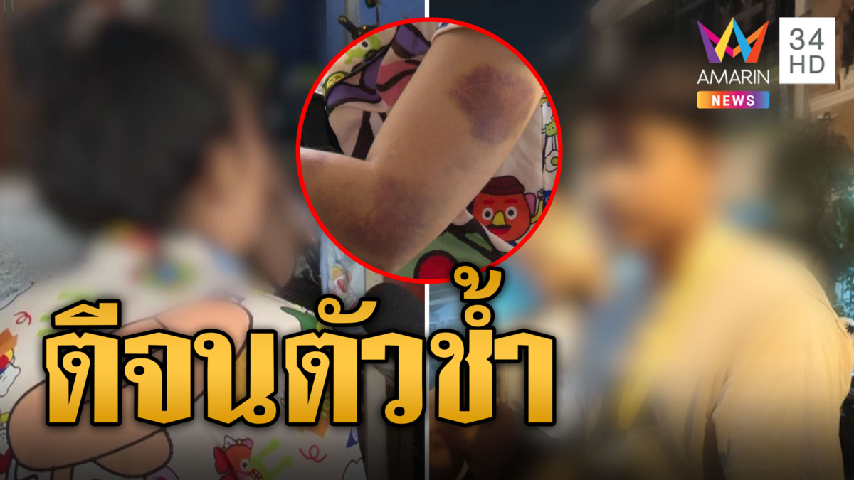 สาวสุดช้ำ! แฟนสายโหดไม่ให้สังสรรค์ ตีจนตัวเขียว