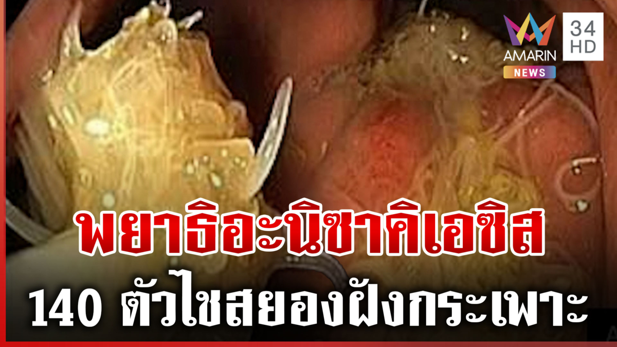 เตือนสายกินปลาดิบ! ปวดท้องรุนแรง ตรวจเจอพยาธิอะนิซาคิเอซิส