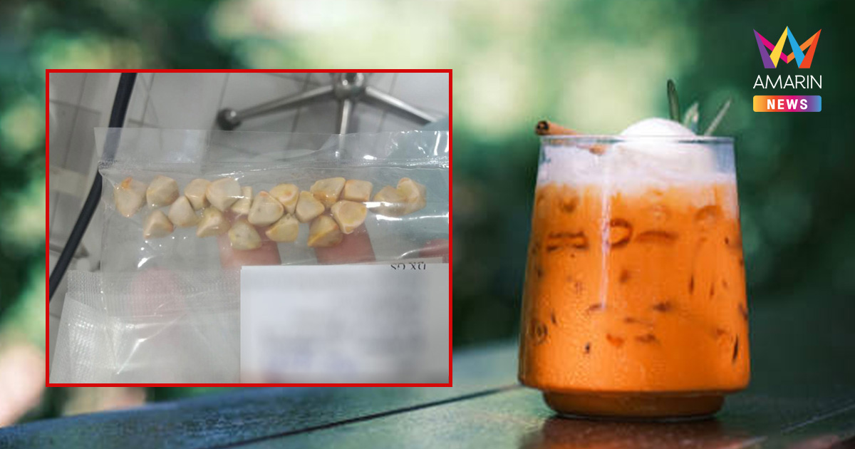เตือนสายหวาน! อุทาหรณ์คนชอบกิน "ชาเย็น" ทุกวัน เจอนิ่วสูงสุด 22 เม็ด