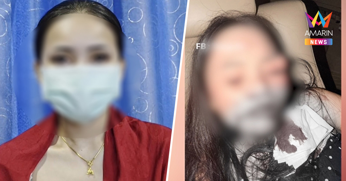 “น้องโอ๋” เหยื่อแก้วฟาดหน้าเปิดใจสุดช้ำ ชีวิตเปลี่ยน ยันฟ้องถึงที่สุด