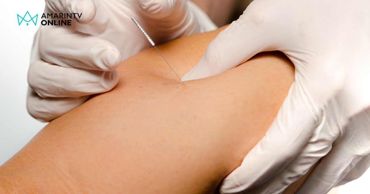 หยุดความปวดจากออฟฟิศซินโดรม ด้วยการฝังเข็ม Dry Needling