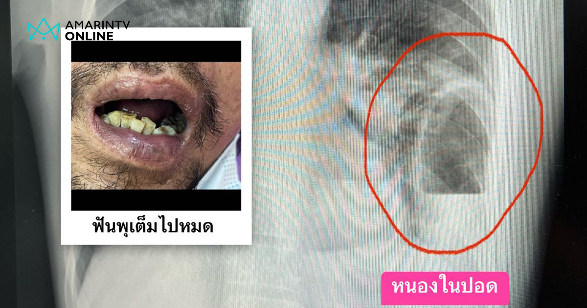 กินแต่เหล้า ฟันไม่แปรง ติดเชื้อรากฟัน พบหนองในปอด