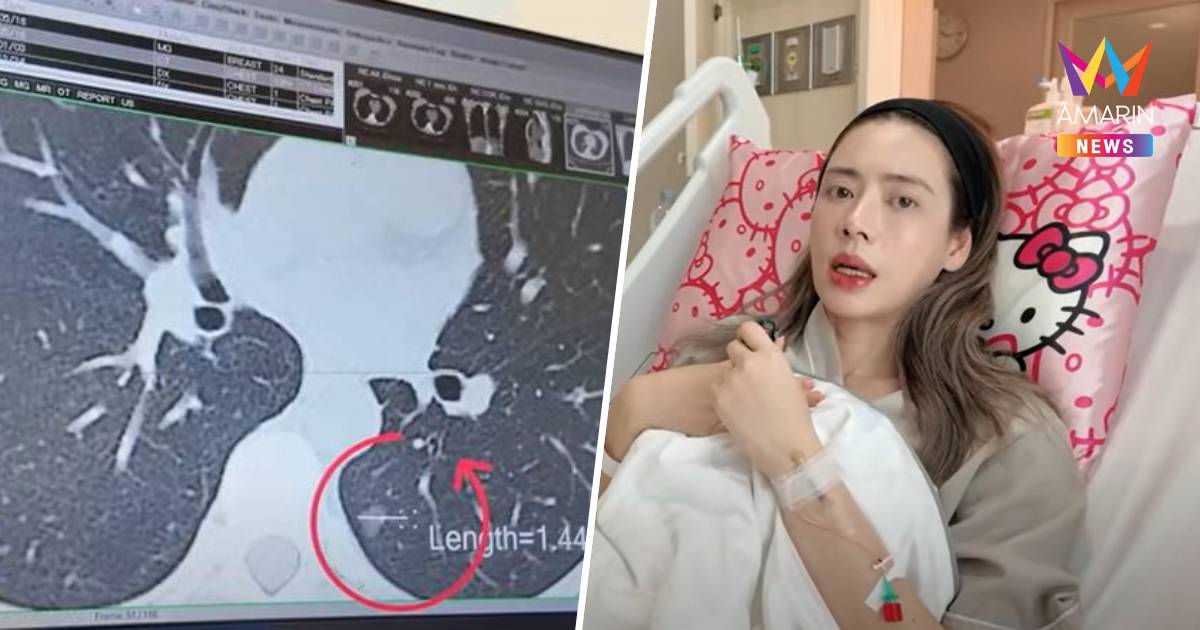 "เอ๋ พรทิพย์"ผ่าตัดมะเร็งปอดระยะแรกบอกตอนนี้หายแล้ว ขอบคุณทุกกำลังใจ