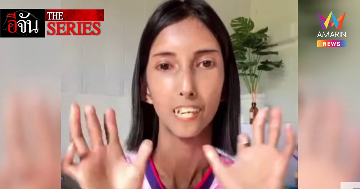 สาวป่วยโรคหายาก "ผิวหนังแข็ง" เผยอาการแรกเริ่มก่อนถึงจุดชีวิตพลิก