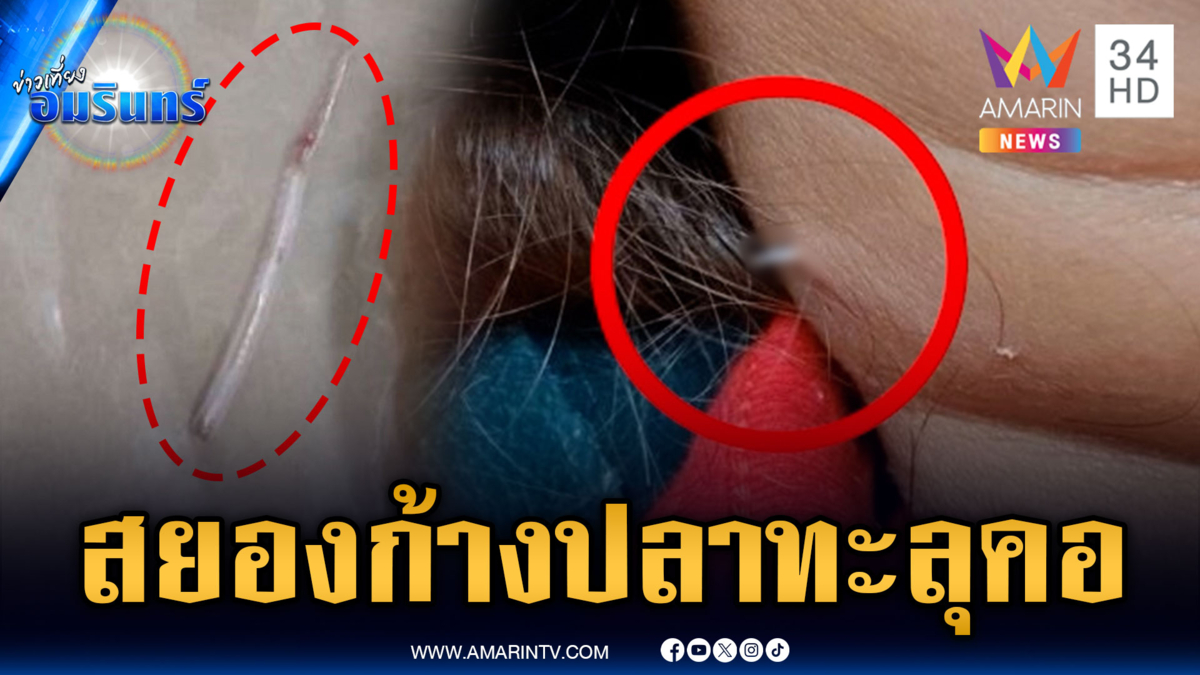 อุทาหรณ์สายกินปลา จากก้างติดคอรุนแรงถึงขั้นทะลุ