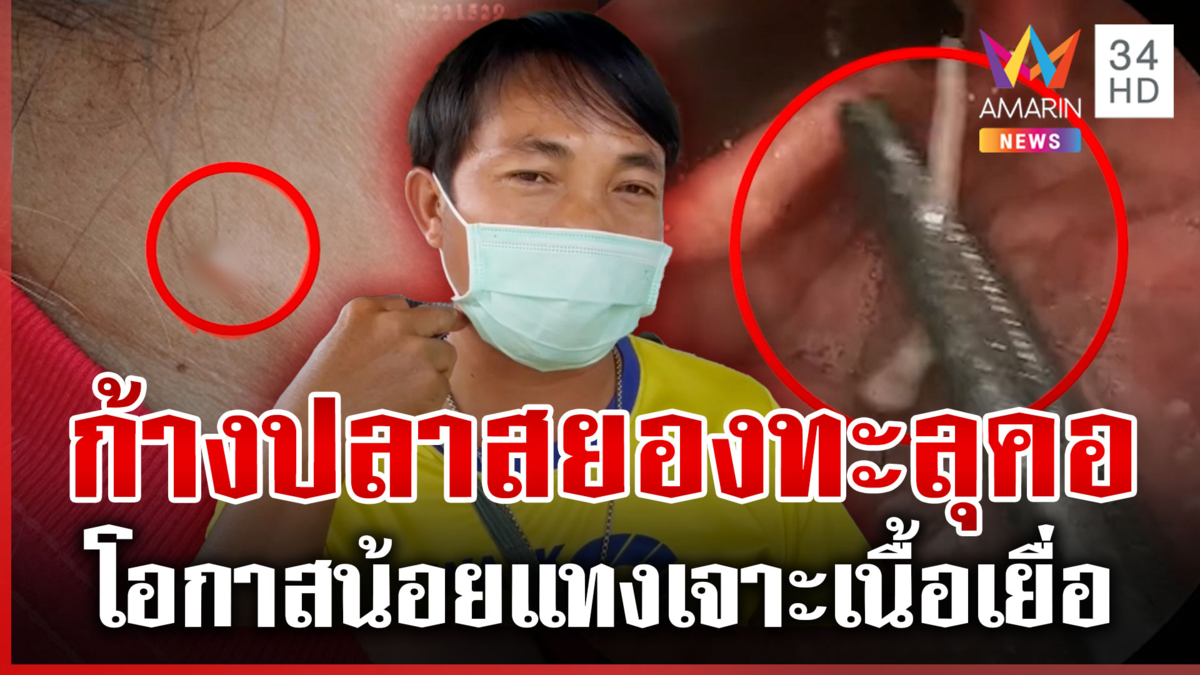 “หมอหมู” ไขคำตอบก้างปลาแทงทะลุคอ ได้จริงหรือไม่