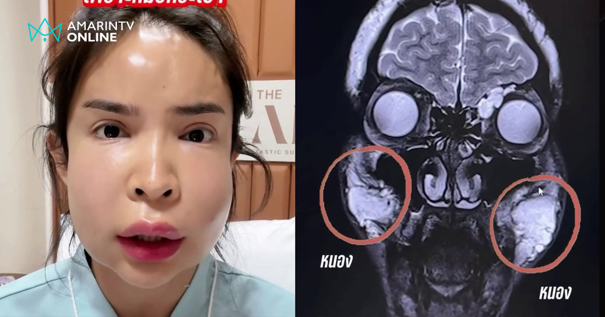 สวยแลกเสี่ยง! บทเรียนราคาแพง "นัท นิสามณี" กับพิษฉีดหน้าจากหมอกระเป๋า