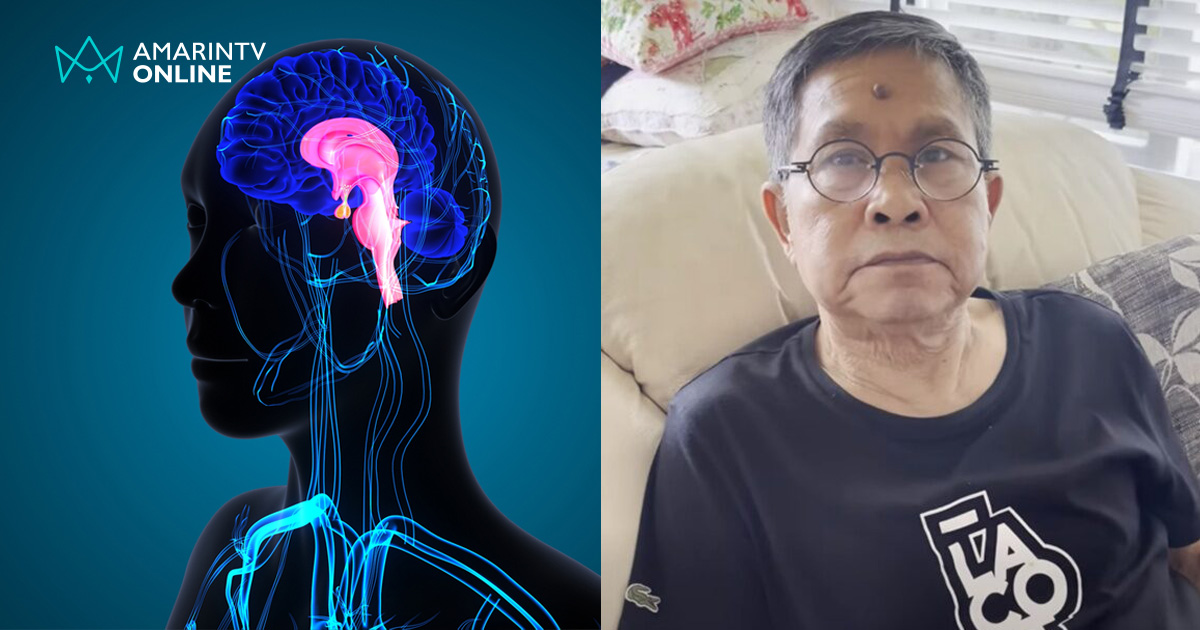 ปัจจัยเสี่ยงป่วย "สโตรกก้านสมอง" ใครก็เสี่ยงเป็นได้แบบ เด๋อ ดอกสะเดา
