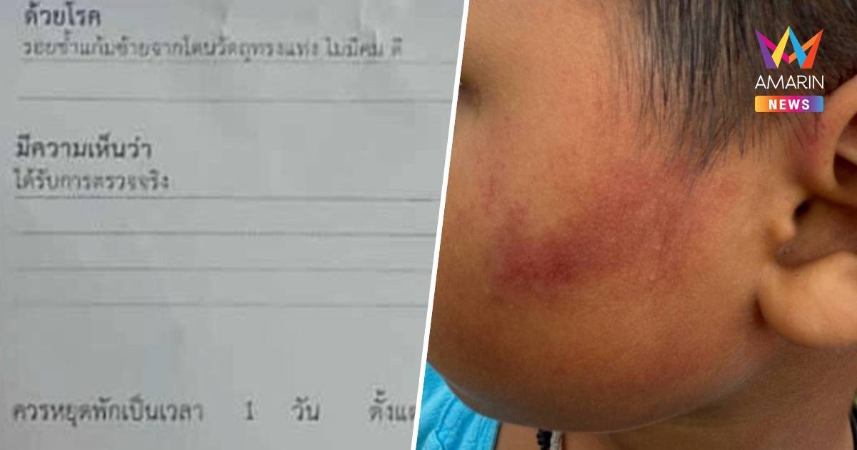 ครูสาวโหด!ใช้ฟุตเหล็กฟาดหน้าด.ช. 7 ขวบ เหตุหยิบขนมกิน