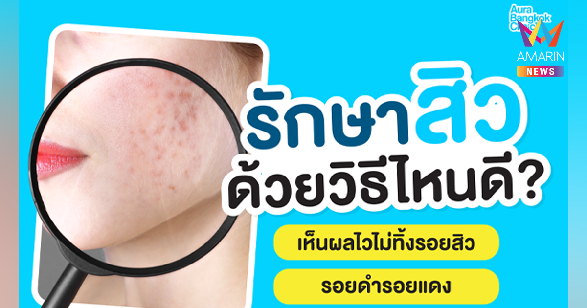 รักษาสิวด้วยวิธีไหนได้บ้าง? ที่เห็นผลจริง ไม่เลี้ยงไข้ ไม่ทิ้งรอยสิว