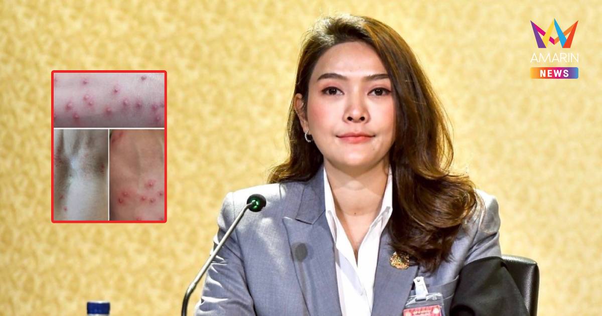 พบป่วย “ฝีดาษวานร” สะสมเกือบ 1 พันคน เพศชายมากสุด กทม.มีผู้ป่วยสูงสุด