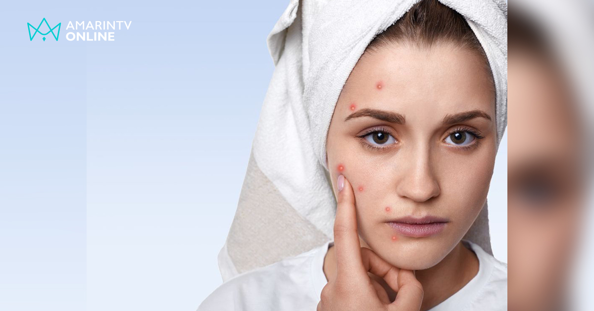 รักษาสิวอย่างถูกวิธี โดยแพทย์ผิวหนัง เห็นผลจริง ปลอดภัย