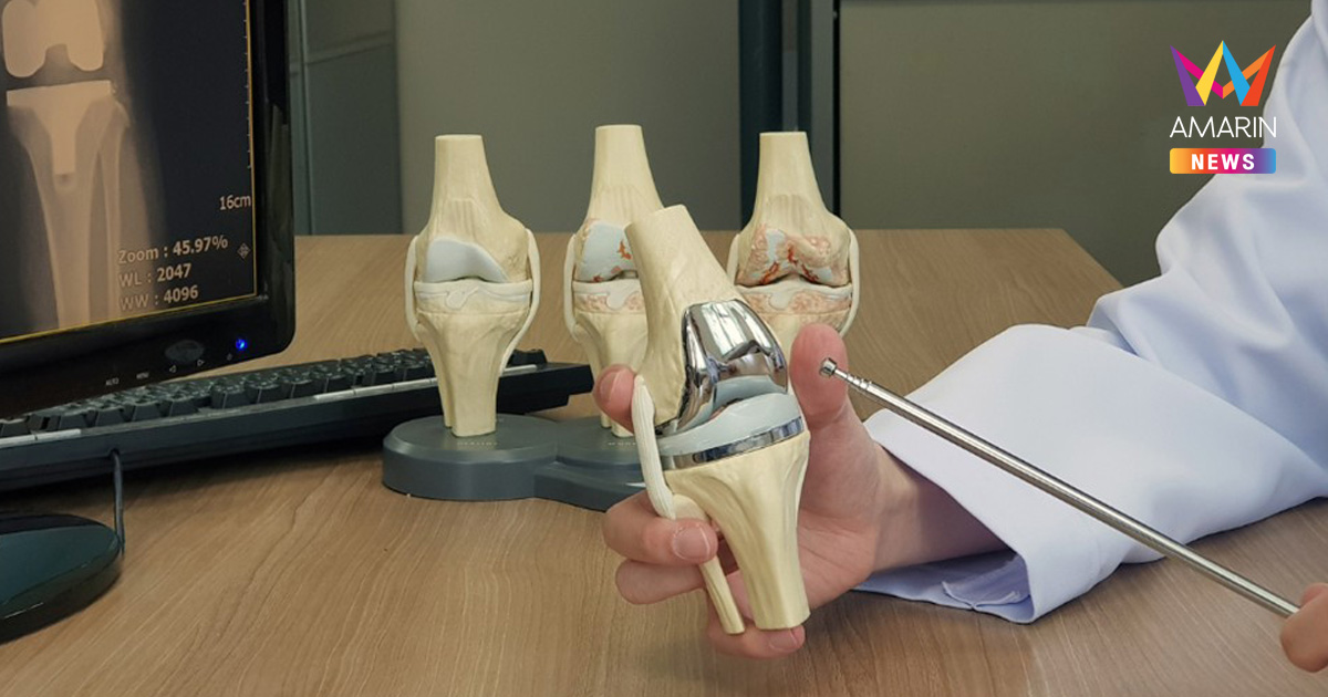 เปิดข้อดีการผ่าตัดเปลี่ยนข้อเข่าเทียมด้วยเทคนิค Muscle Sparing