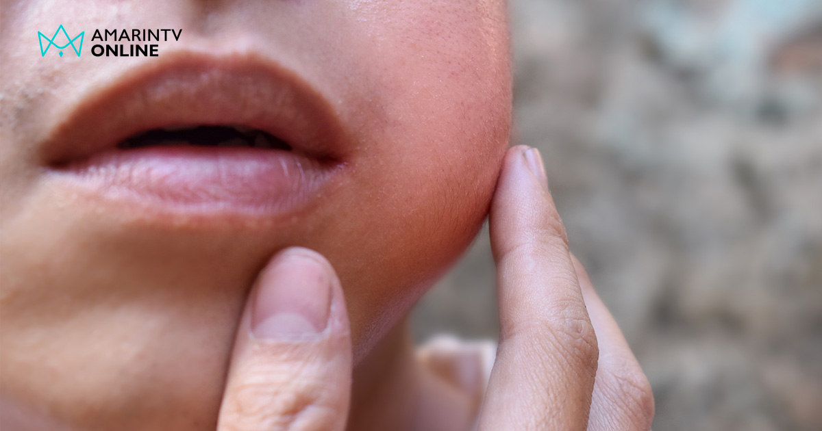 คางทูม ระบาดวัยรุ่น-วัยทำงาน หมอย้ำถ้ามี 3 อาการนี้ให้สงสัยเลยว่าเป็น