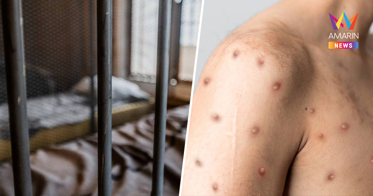 นักโทษป่วย "ฝีดาษวานร" ในเรือนจำเสียชีวิตแล้ว 1 ราย