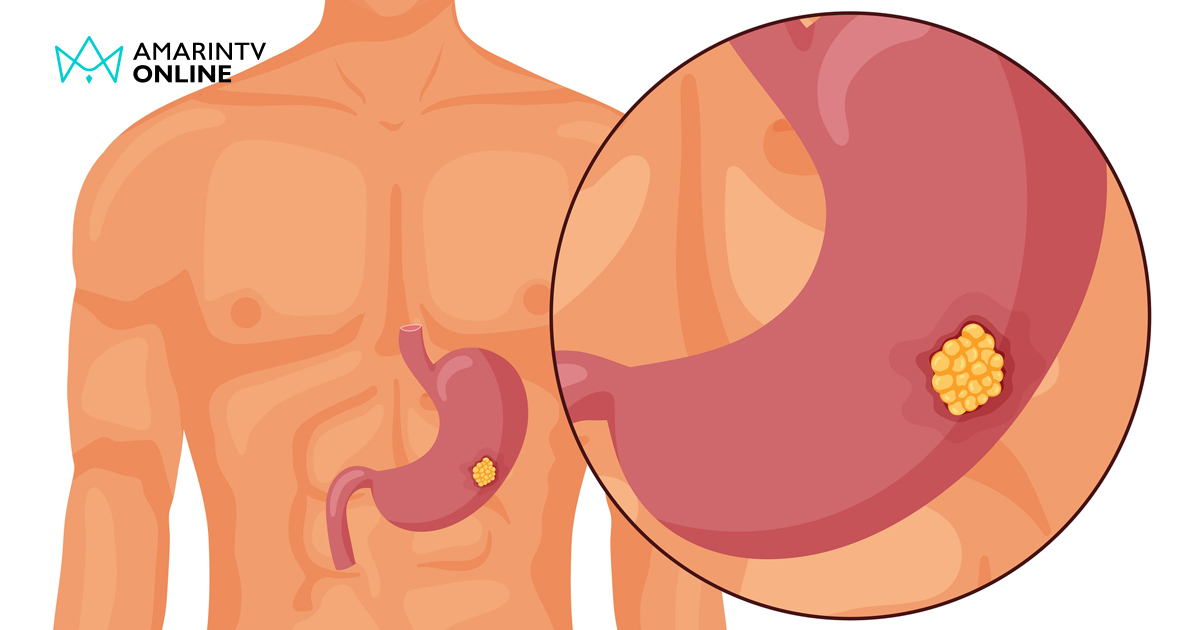 มะเร็งจิสต์ คืออะไร พบได้ไม่บ่อย เกิดได้ทุกส่วนของระบบทางเดินอาหาร