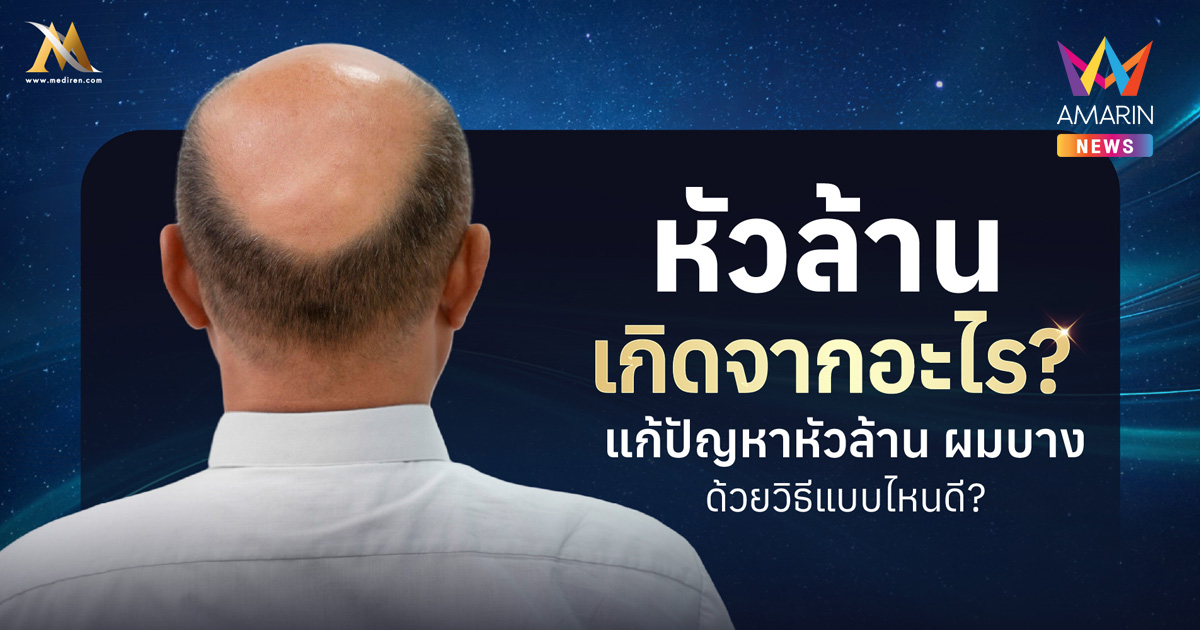 หัวล้านเกิดจากสาเหตุอะไร? เรียนรู้วิธีแก้หัวล้านที่เห็นผล