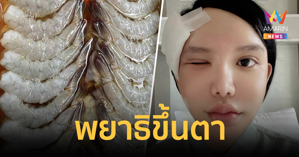 อุทาหรณ์สายดิบ! พยาธิขึ้นตา หลังหม่ำกุ้งแช่น้ำปลา แอดมิทนาน 10 วัน