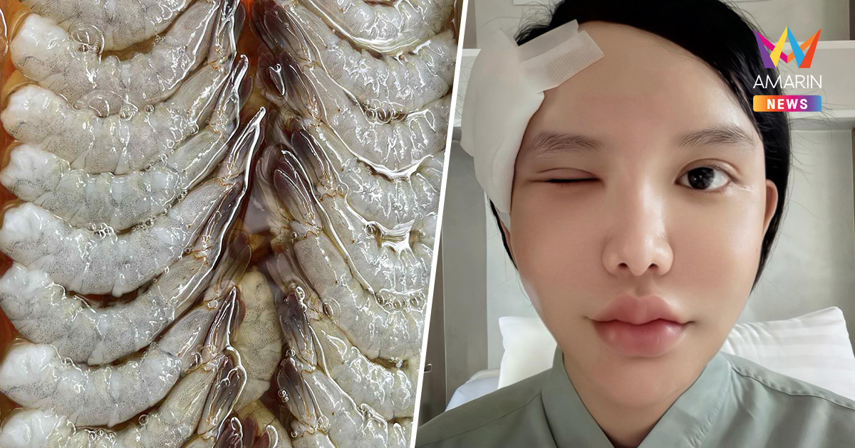 อุทาหรณ์สายดิบ! พยาธิขึ้นตา หลังหม่ำกุ้งแช่น้ำปลา แอดมิทนาน 10 วัน
